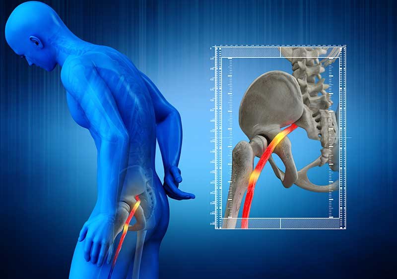 Chiropractic for Sciatica - Chiropractic for Sciatica