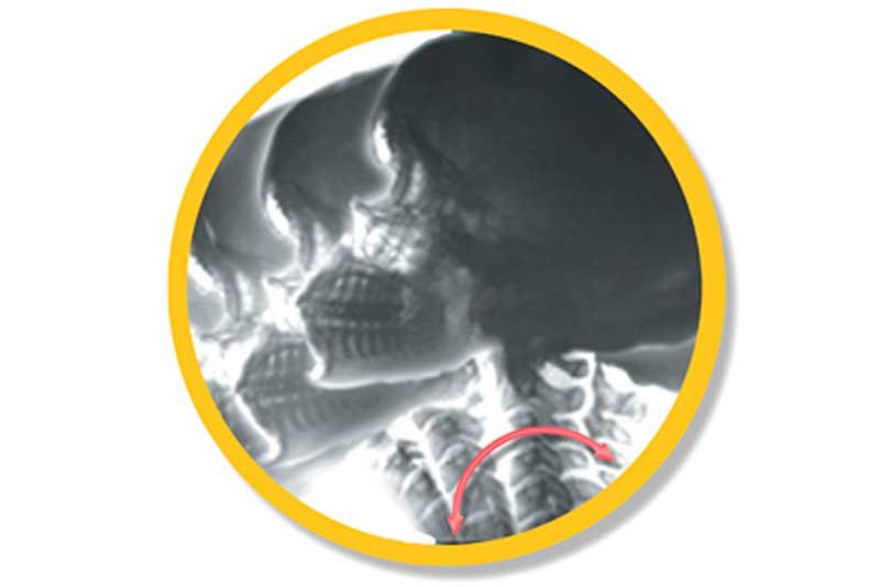 DMX - Digital Motion X-Ray Identifies Ligament Injuries Not Detectable By MRI, CT, Or Static X-RaysX-Rays - Digital Motion