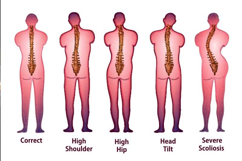 Sunset Chiropractic & Wellness Research Review: Association Between Incorrect Posture and Scoliosis - Association Between Incorrect Posture and Adolescent Idiopathic Scoliosis Among Chinese Adolescents