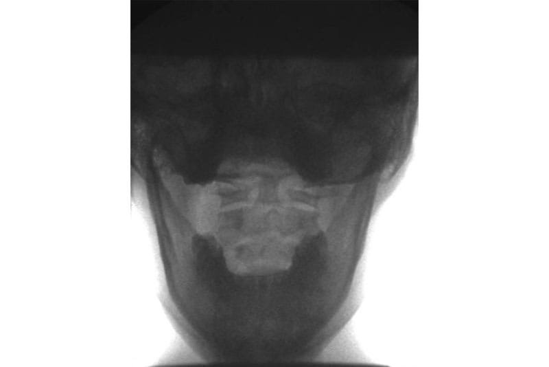 Most Common Misdiagnosed Ligament Injuries in the Neck (AKA) Cervical Instability and Injury - Misdiagnosed Ligament Injuries
