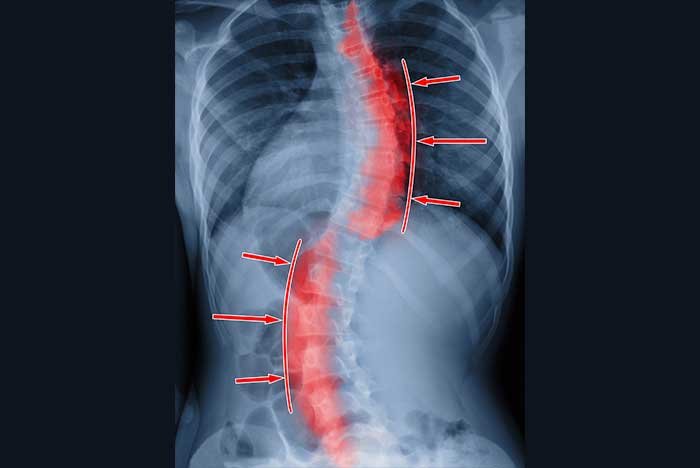 The relationship of hip loading asymmetry and radiological parameters of the spine in Lenke type 1 idiopathic scoliosis - The relationship of hip loading asymmetry and radiological parameters of the spine in Lenke type 1 idiopathic scoliosis
