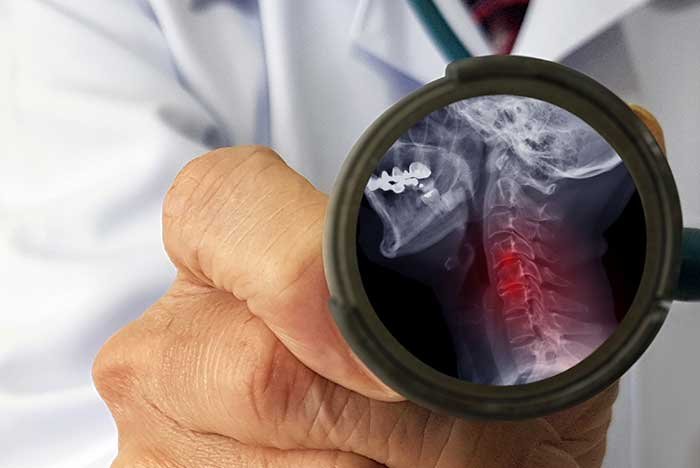 Does cranial incidence angle have a role in the tendency toward cervical degenerative disc disease? A reverse correlation between cranial incidence angle and cervical degenerative disc disease development is demonstrated.