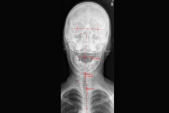 Why Open Mouth Cervical X-Rays?