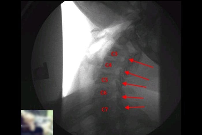 Sunset Chiropractic and Wellness. Digital Motion X-ray (DMX) Identifies Ligament Damage Undetected With MRI. Digital Motion X-ray, or DMX, is a state-of-the-art imaging technology that allows medical professionals to observe the movement and alignment of joints, ligaments, and bones in real-time.